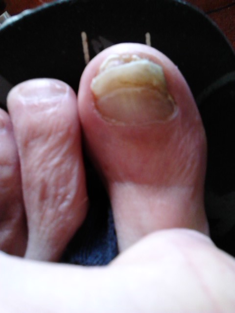 It was 9 months ago on the 1st of this month and the toe STILL isn't healed
